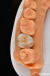 Dental Multilayer Full Zirconia Crowns And Bridges High Translucent Natural
