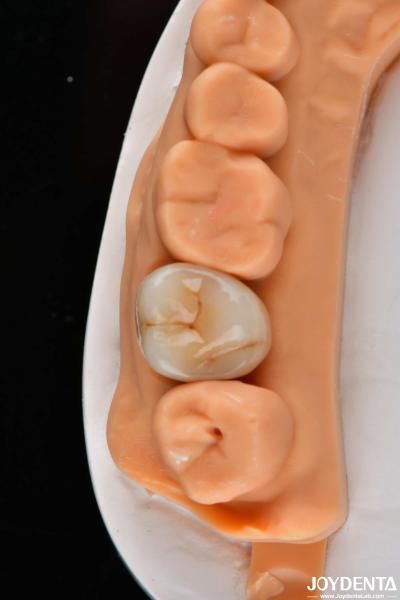 Dental Multilayer Full Zirconia Crowns And Bridges High Translucent Natural