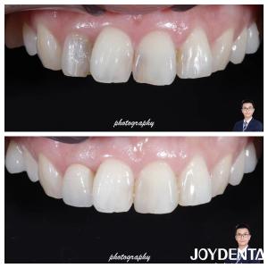 China Aesthetics Translucency Zirconia Crowns Natural Looking High Fracture Resistance factory