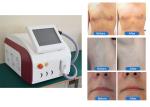 900W 12*20mm 1064nm Laser Hair Removal Equipment