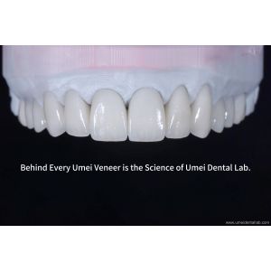 China Ultra-thin aesthetic restorative veneers on sale