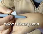 Non Invasive 30MHz Vascular Age Spot Removal Machine