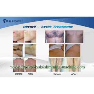 TEC + Water + Air Cooling 808nm Diode Laser Hair Removal Machine Fast Speed and