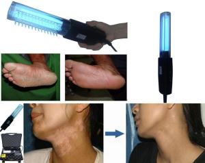 China Psoriasis Uvb 311nm Phototherapy 200V Uvb Vitiligo Lamp factory