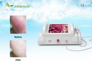 China New Technology Rbs Vascular Removal / Spider Veins Removal Rbs Vascular factory