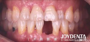 China Customizable Dental Maryland Resin Bonded Bridges for Anterior And Premolar Teeth factory