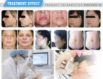 10600nm Fractional Co2 Laser Skin Resurfacing Machine Erbium Yag Laser