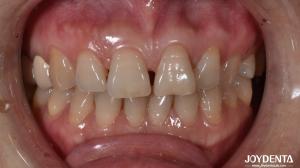 China 0.5mm Thickness Ceramic Dental Veneers Natural Looking For Anterior Tooth Indication factory