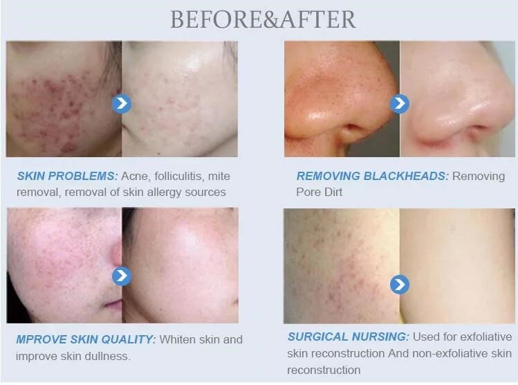 1.1MHz 30L Oxygen Spray Facial Machine , Diamond Peeling Microdermabrasion Machine