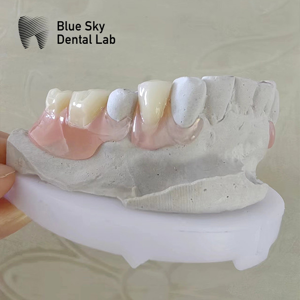 Smile Restoration Partial Acrylic Denture with clasps