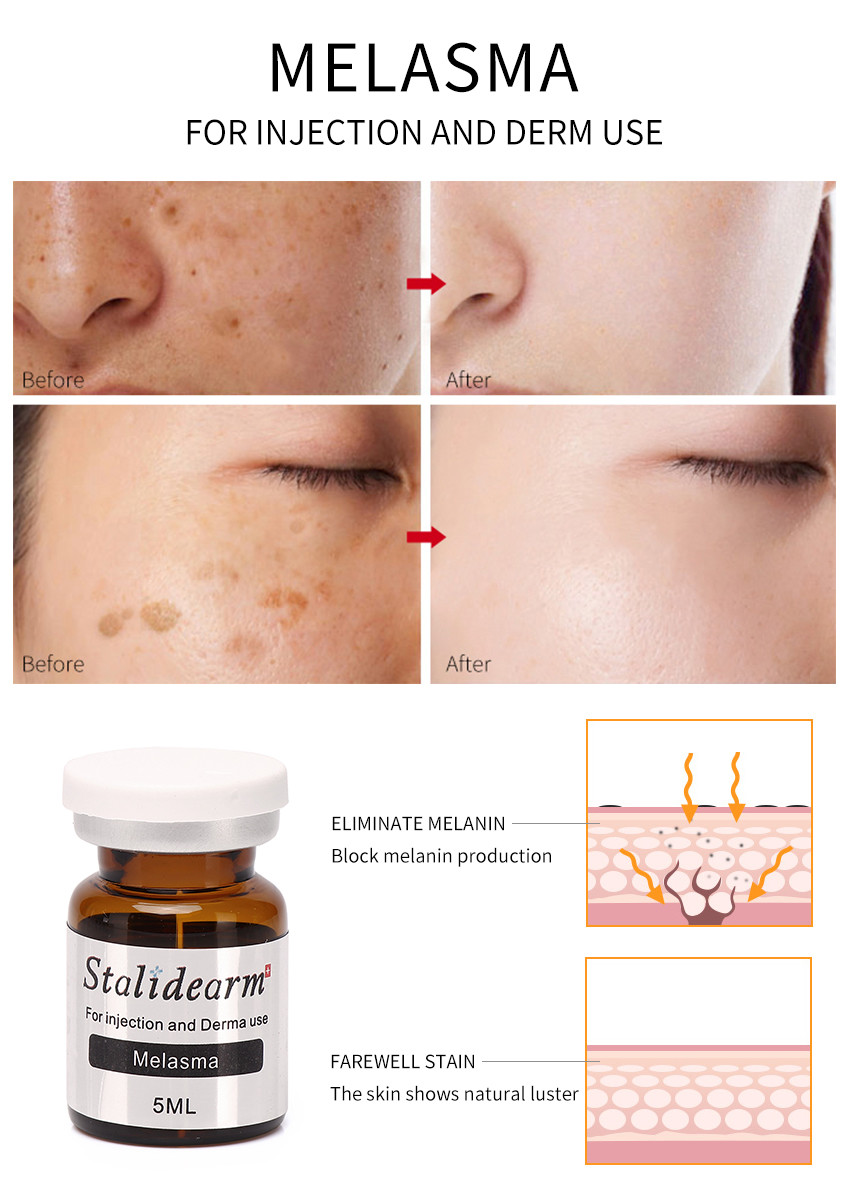 Stalidearm Original Youth Serum Injection For Melasma Safe Natural Looking Effect