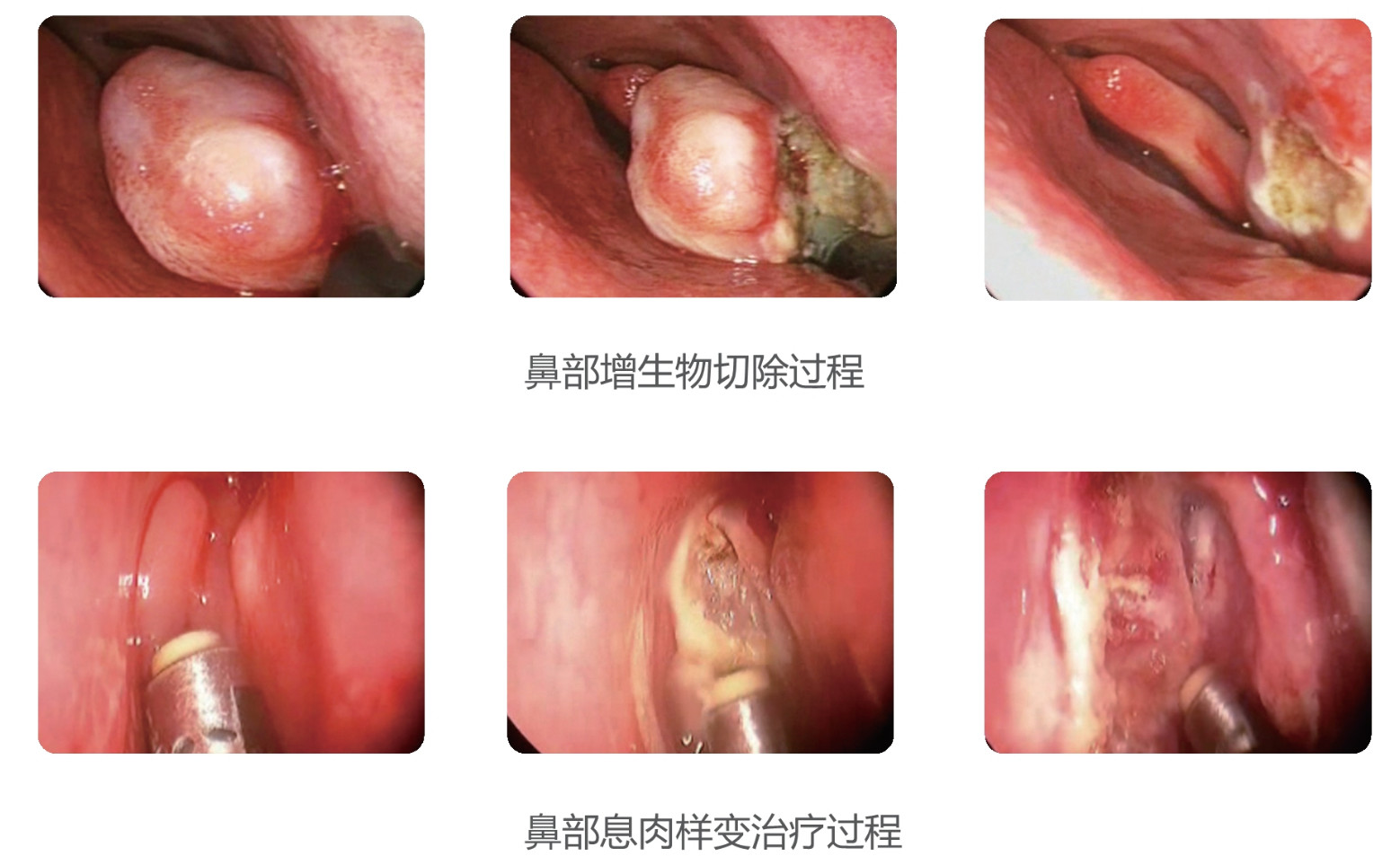 RF Plasma Surgical Coblator for Tonsillectomy and Adenoidectomy