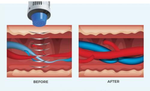 Shock Wave Vacuum Cellulite Reduce Machine For Phsio Therapy