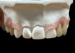 Tailored Secure Fit invisible Flexible Parital Denture Replacement For