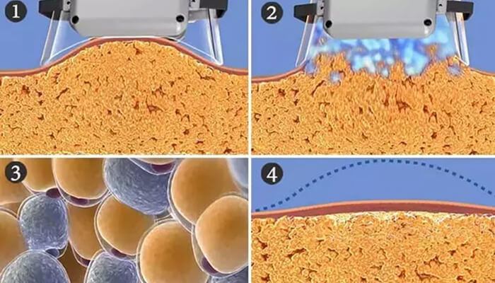 Fat Reduction Multifunctional Fat Removal Machine Combines Cryo And HIEMT