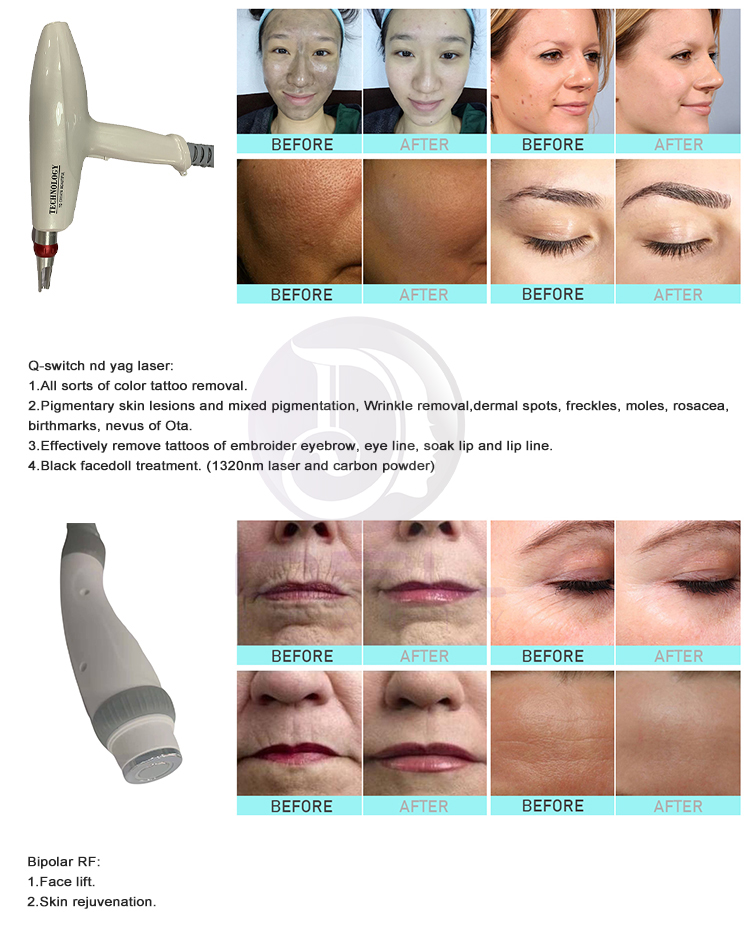 DPL Laser Picosecond 4 IN 1 Dioda Hair Removal And Tatoo Removal Machine RF Face Lift 808 diode pico laser hair removal machine
