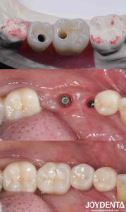 China Cylindrical All On 4 Titanium Dental Implants 10-16mm Length Hex Connection factory