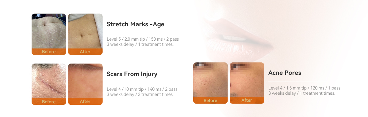 High Quality Acne Removal Microneedling Radio Frequency Rf Microneedling Vacuum Rf Microneedle Machine