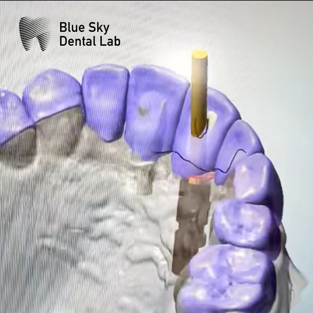 Ti Base Screw Retained Abutment Implant Angulated Screw Channel abutment