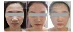 Hyaluronic Acid PCL Skin Booster Miracle Touch Up Skin Collagen Stimulator
