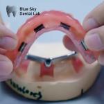 Acrylic Denture Dental Titanium Bar With Attachments Silver And Gold