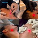 Newest Endolaser 1470nm 980nm Diode Laser Face Lifting Liposuction Machine Air
