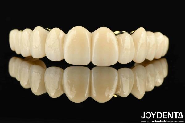 Custom-made Ti-Bar Zirconia Hybrid Bridge The Perfect Combination For Comfort