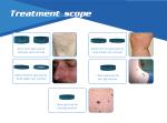 2018 Newest invention painless 980nm laser spider vein / vascular removal