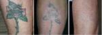 Beauty Clinic Equipment Q Switch Ng Yag Tattoo Removal 1064/532nm laser