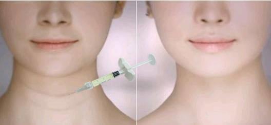 China Achieve Plumper Lips With Dermal Lip Fillers Neck Lines Filling Face Wrinkles Filler factory