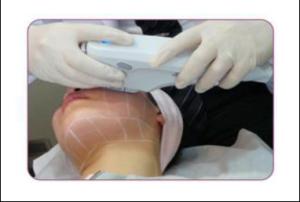 China high intensity focused ultrasound hifu for wrinkle removal / hifu face lift factory