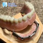 Full Upper Dental Titanium Bar Full Mouth Restoration Blue Sky Implant