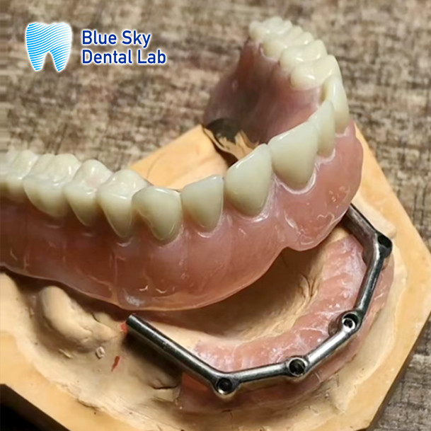 Removable Dental Titanium Bar For Dentures Blue Sky
