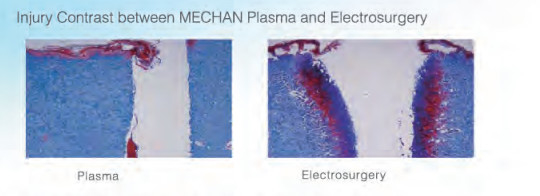Non Thermal Minimally Invasive ENT Plasma Surgery System For Turbinate Reduction
