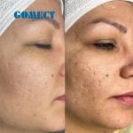 Professional Microneedle RF Machine with Adjustable Depth for Skin Rejuvenation