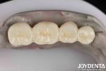 Excellent White Product Full Zirconia With High Resistance To Corrosion