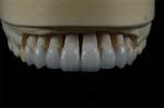 Long Lasting Permanent White Dental Porcelain Veneers Stain Resistance