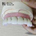 Universal Implant Procedure Cases Full Mouth Implant Case Customized