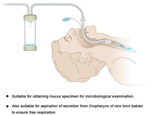 E.O. Sterilized Disposable Mucus Extractor with 3 Years Shelf Life for Pediatric and Adult Airway Management