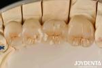Unleash Aesthetics Of High Aesthetics Full Zirconia With White And Resistance To