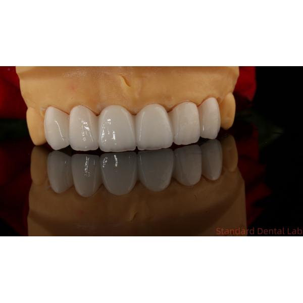 Full Contour Zirconia Crown Translucency 3D PRO No Porcelian Overlay Standard Dental Lab
