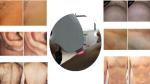 painfree 24h working continuously 808 diode laser hair removal with best