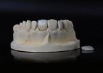 Translucency Porcelain Emax Veneer for Excellent Fit / Natural Esthetics