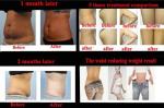 direct factory !!! high quality and competitive price Cryolipolysis Slimming