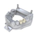 High Precision Permanent Crown Resin 3d Printing Technology For All-Ceramic