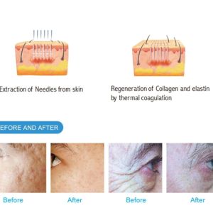 Most Advanced Fractional Rf Microneedle Machine/ Rf Microneedle Radio Frequency