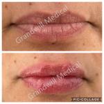 Hyaluronic Acid Lip Injections Natural Looking Lip Fillers Non Surgical Lip