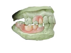 China Flexible Denture Base Resin For Partially Edentulous Restoration Stable And Comfortable factory