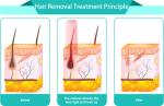 CE approved new laser diode 808nm products laser hair removal training Nubway