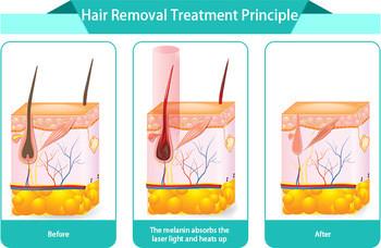 CE approved new laser diode 808nm products laser hair removal training Nubway